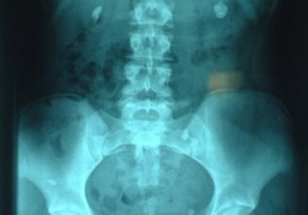 Kidney stones An X-ray showing the pelvis, ribcage and and two clear dots either side of the spine with are kidney stones.
