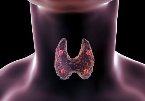 Graphic of the glands in the neck